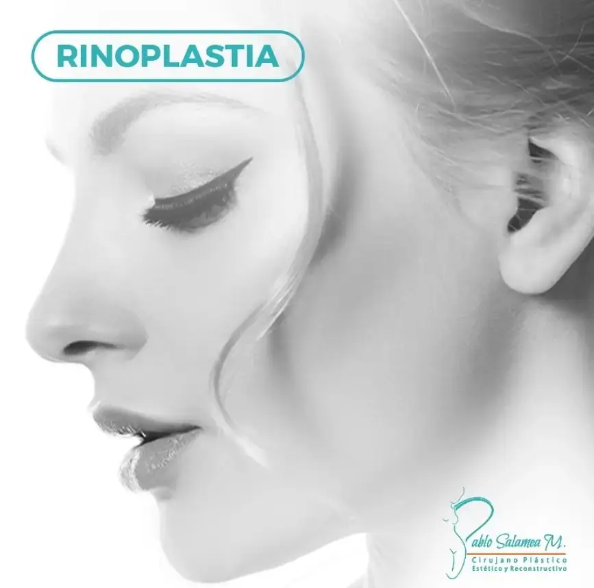 rinoplastia en cuenca, ecuador. Dr. Pablo Salamea especialista en cirugía plástica.