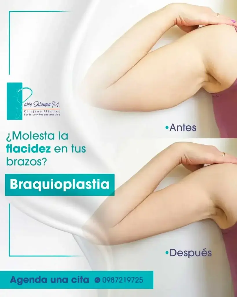 braquioplastia, Dr. Pablo Salamea, cirujano plástico